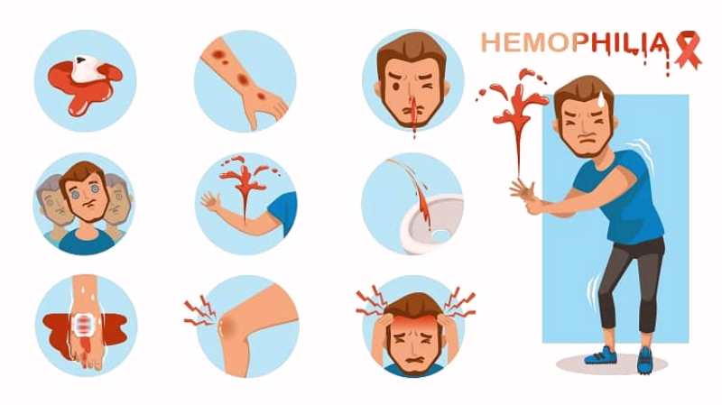 हीमोफीलिया hemophilia